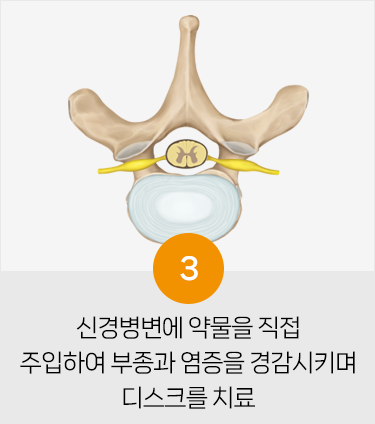 척추 주사 치료방법3