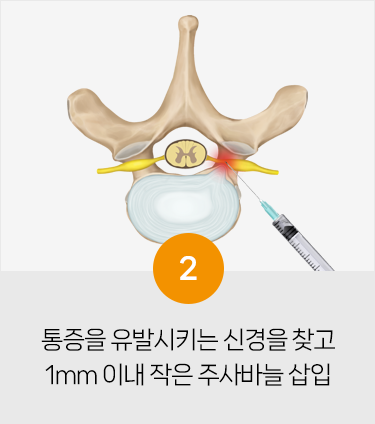 척추 주사 치료방법2