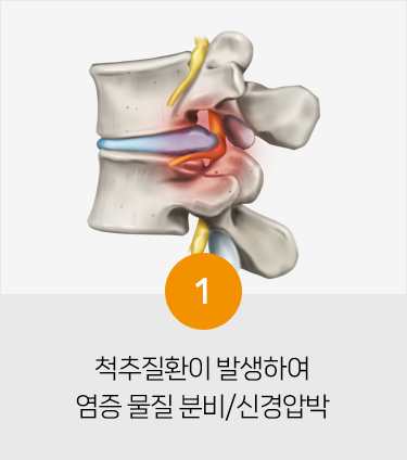 척추 주사 치료방법1